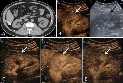 Contrast-enhanced ultrasound manifestations of renal masses undetectable on conventional ultrasound